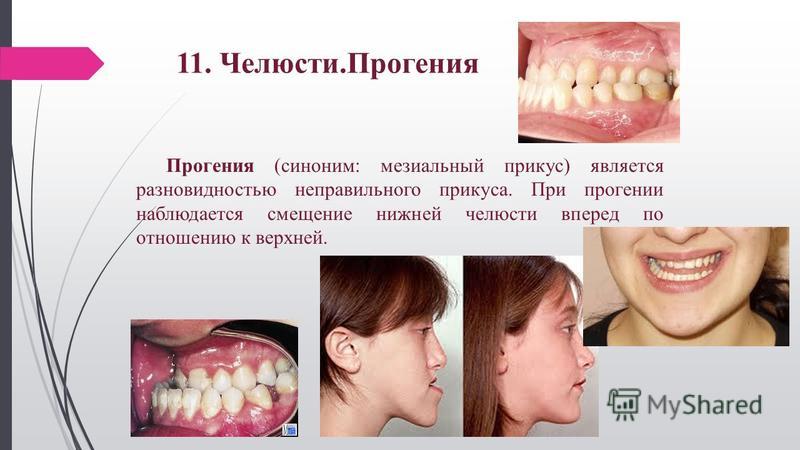 Лечение мезиальной окклюзии. Прогения нижней челюсти мезиальный прикус. Неправильный прикус прогения. Истинная и ложная прогения. Прогения верхней челюсти.