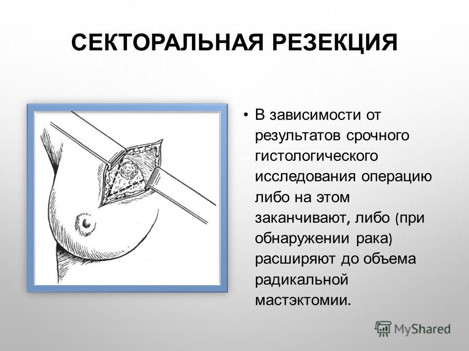 Что значит резекция молочной железы