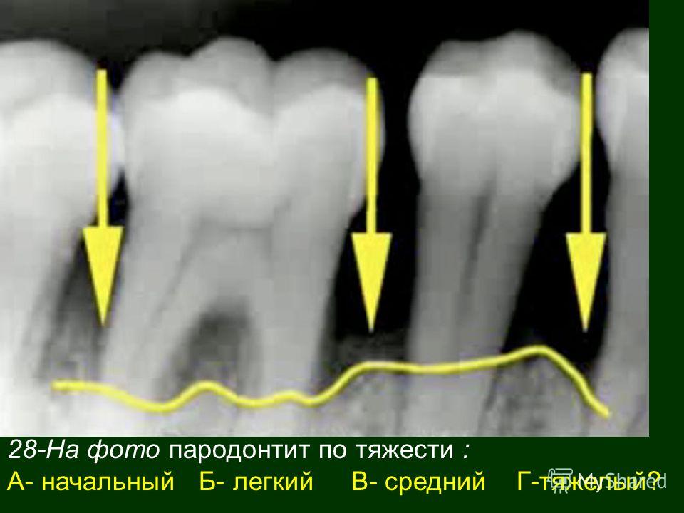 Резорбция кости