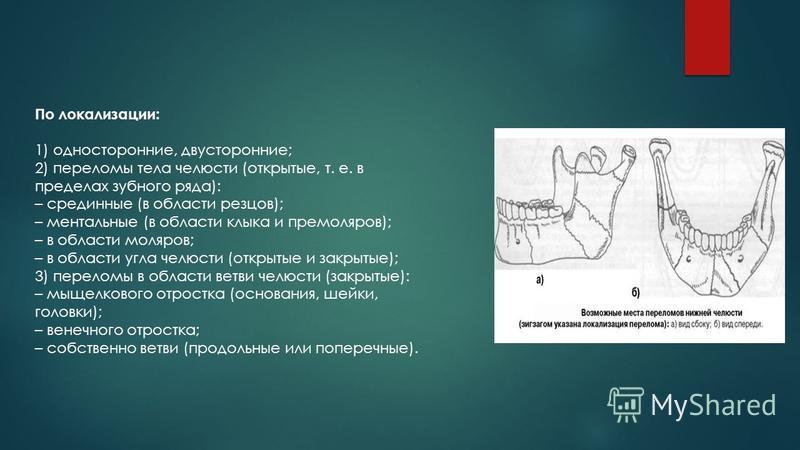 Переломы верхней и нижней челюсти презентация