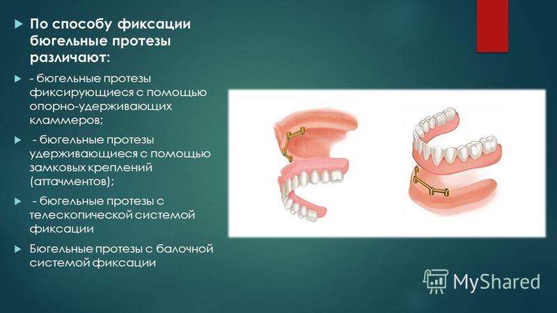 Фиксация бюгельных протезов