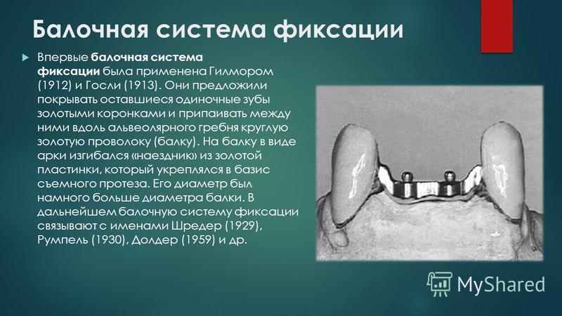 Противопоказания бюгельных протезов. Методы фиксации бюгельного протеза. Балочная система фиксации. Бюгельные протезы балочная система.