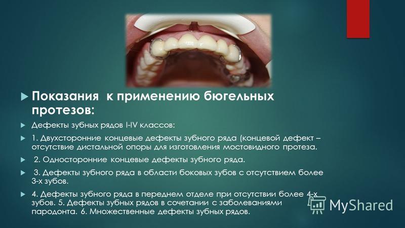 Отсутствие дефектов. Показания к применению бюгельных протезов. Бюгельные протезы показания. Бюгельный протез показания. Показания для бюгельных протезов.