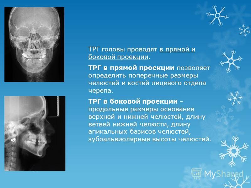 Трг проекции. Телерентгенография черепа в боковой проекции. ТРГ В прямой проекции ортодонтия. ТРГ черепа в прямой проекции.