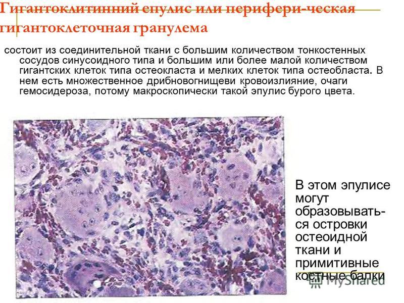 Вид эпулиса в зависимости от гистологической картины