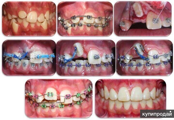 Брекеты вологда. Стоматолог детские брекеты. Ортодонтия в стоматологии детская.