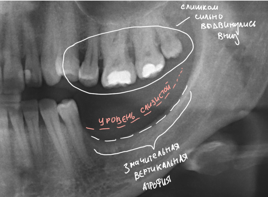 Остеосклероз на рентгене зуба. Атрофия костной ткани нижней челюсти кт. Атрофия костной ткани челюсти рентген. Убыль костной ткани челюсти на снимке.