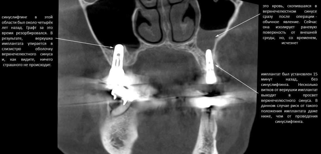 Слизистая оболочка верхнечелюстном синусе. Перфорация гайморовой пазухи. Перфорация верхнечелюстной пазухи на кт. Перфорация гайморовой пазухи на кт. Синус лифтинг кт после.