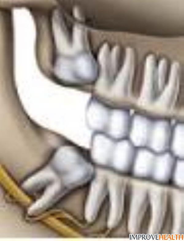 Зуб 8 корень. Зуб мудрости (3-й моляр, восьмерка). Дистопированный зуб мудрости верхний. Зуб мудрости корни восьмеркой.