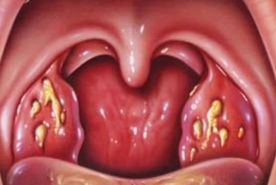 long term tonsillitis