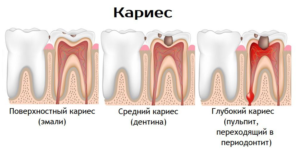 Кариес клиническая картина