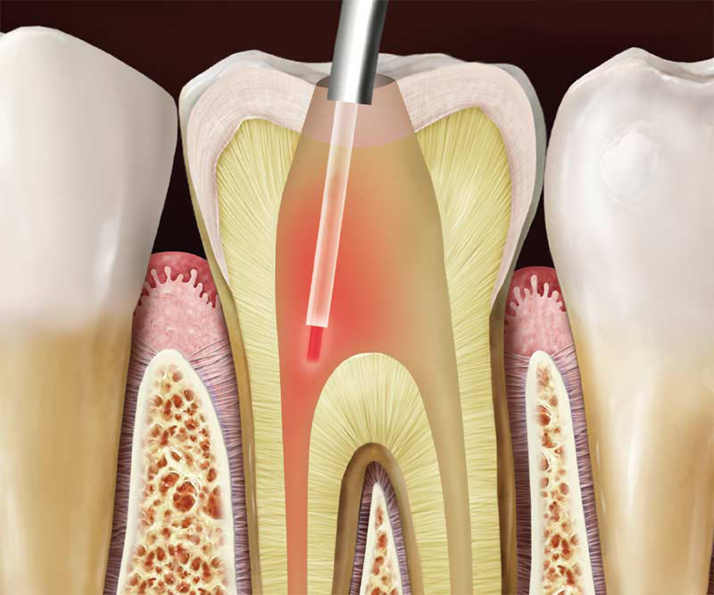 Лазерное десен. Эрбиевый лазер в стоматологии. Лазерная терапия пульпита. Препарирование зубов лазером. Эндодонтия в стоматологии.