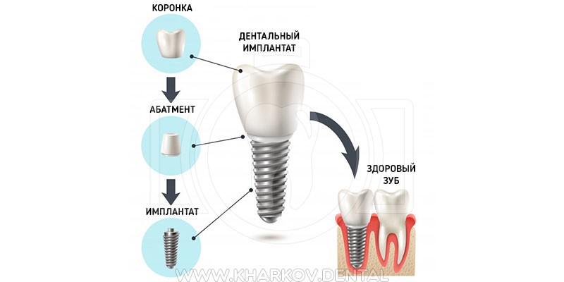 Как делается имплантация зубов на схеме покажите