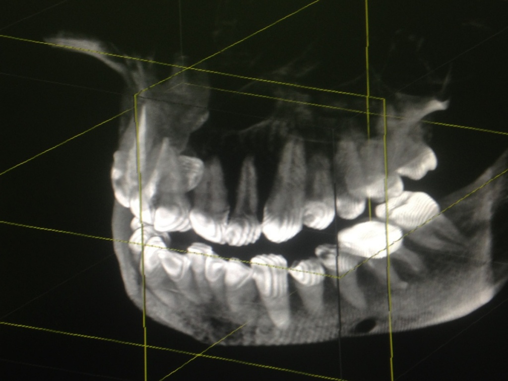 3д снимок челюсти. Кт 3d верхней и нижней челюсти. Компьютерная томография зубов и челюсти – снимок 3d. Кт снимок нижней челюсти.