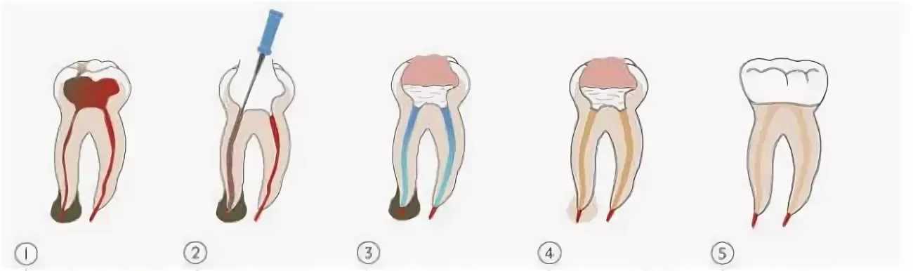 Депульпирование зуба (удаление нерва). Через сколько зуб перестает болеть