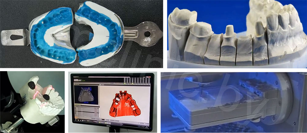 Клинико лабораторные этапы съемных пластиночных протезов. Моделировка Emax коронок. CAD-cam система цифровой оттиск. Клинико-лабораторные этапы мостовидных протезов. Лабораторный этап штампованной коронки.