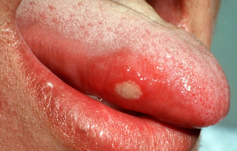 aphthous ulcer pictures 2
