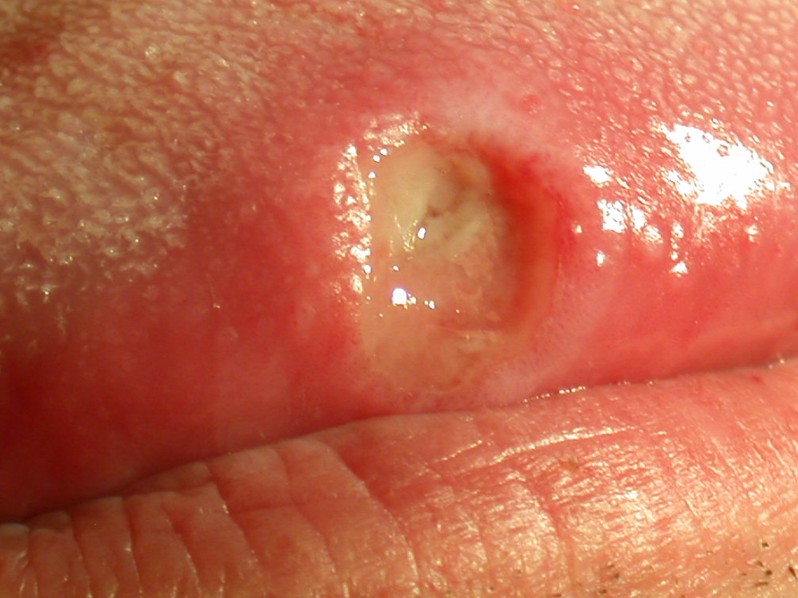 aphthous ulcer pictures 3