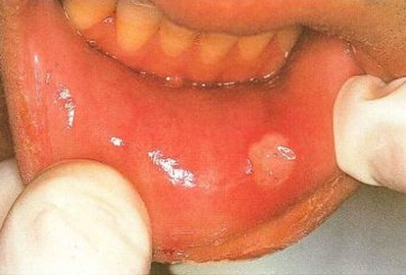 aphthous ulcer pictures 4