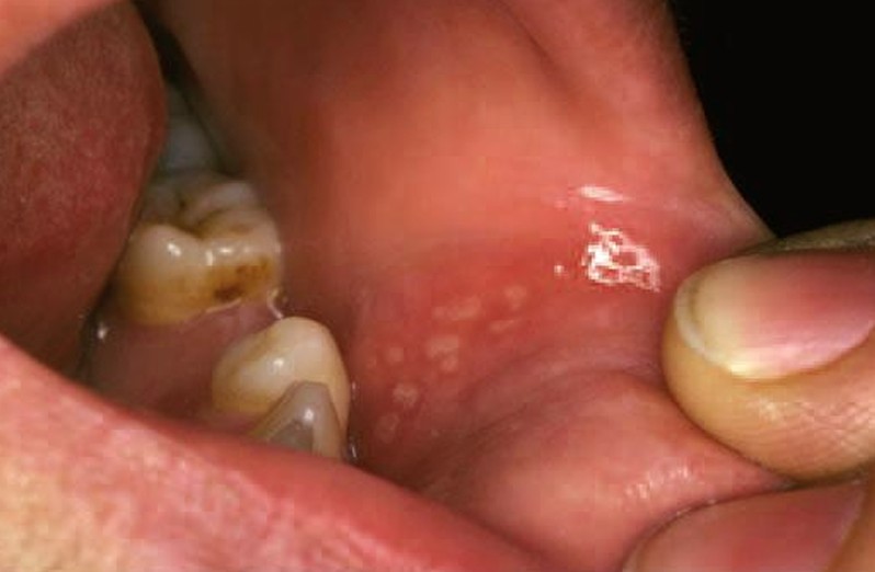aphthous ulcer pictures 5