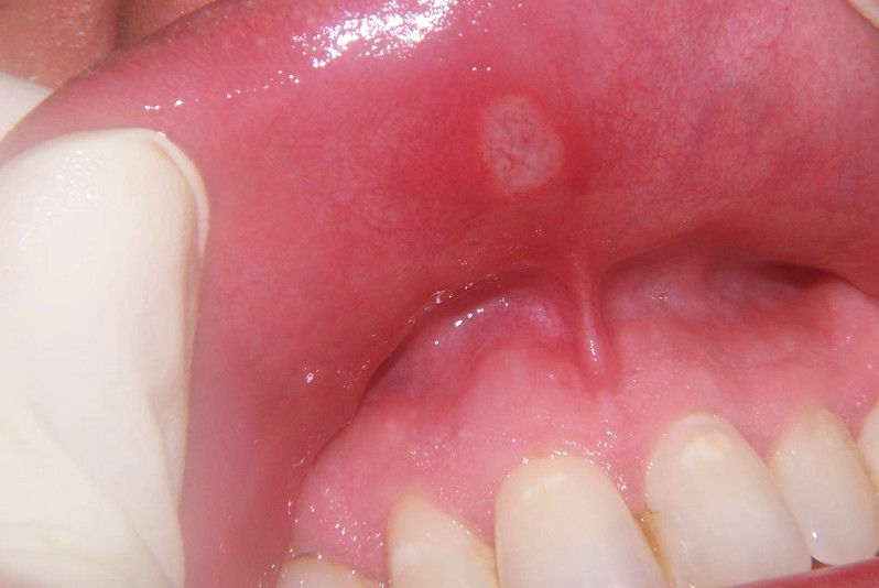 aphthous ulcer pictures 7