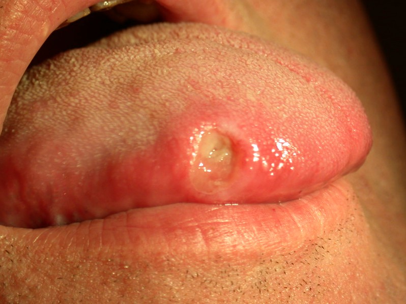 aphthous ulcer pictures