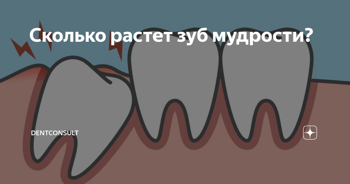 Во сколько лет удаляют зуб мудрости. Прорезавшийся зуб мудрости. Прорезается зуб мудрости. Сколько растет зуб мудрости.