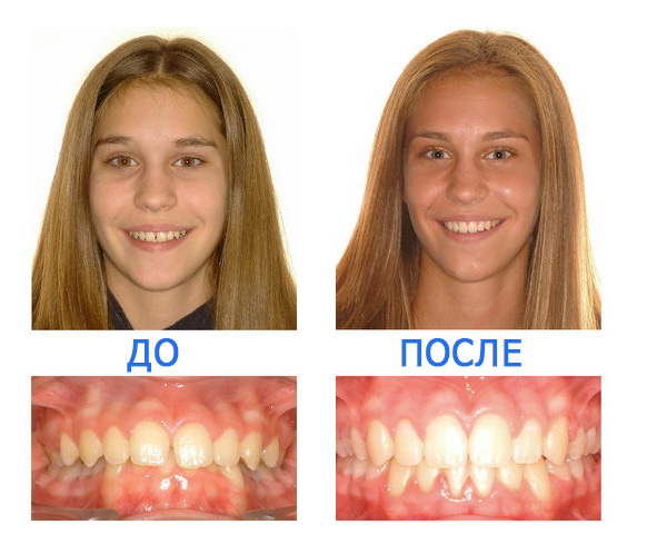 Брекеты до и после. Брекеты до и после зубы прикус. Зубы после брекетов до и после. Глубокий прикус до и после брекетов. Брекеты Результаты до и после.