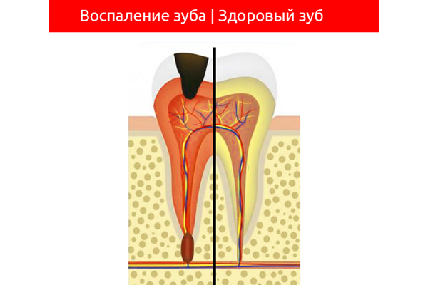 Воспаление зуба. Воспаление надкостницы зуба.