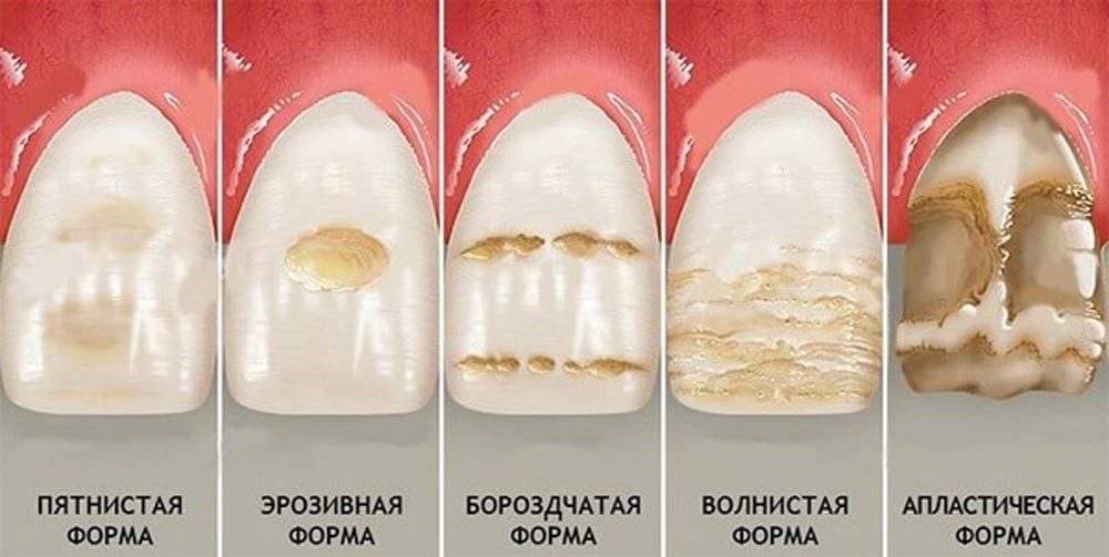 Флюороз у детей фото