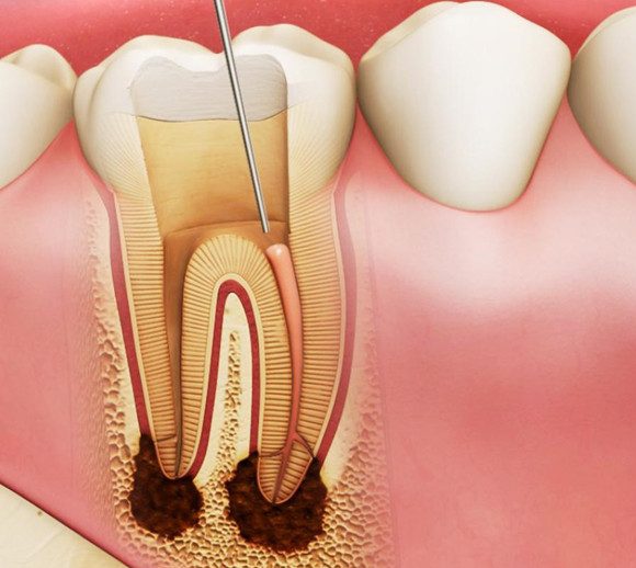 Удаление нерва зуба