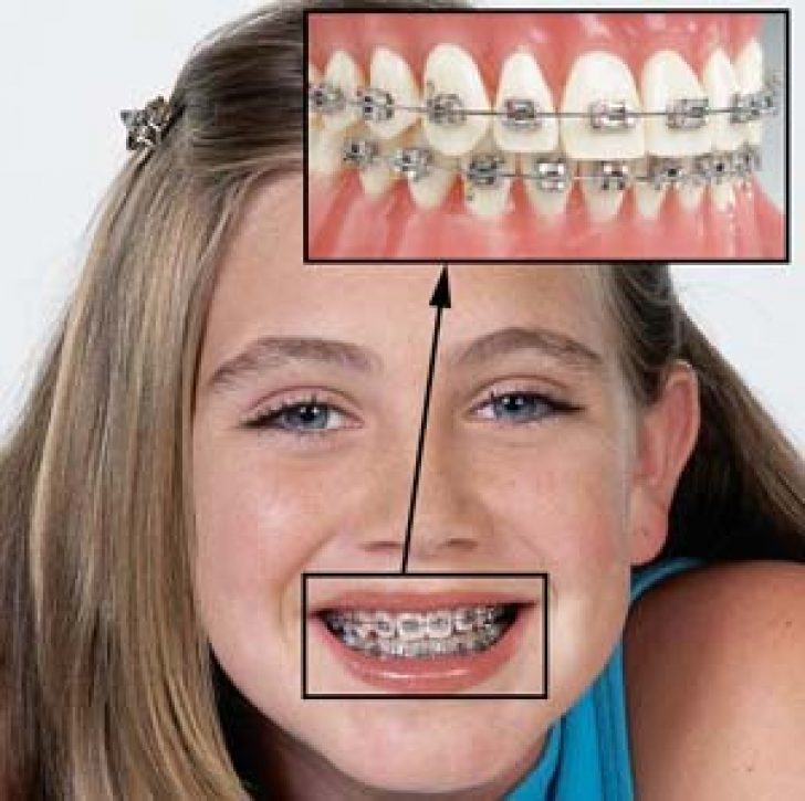 Брекеты на зубы для детей сколько стоят. Исправление прикуса брекетами. Металлические брекеты на кривых зубах.