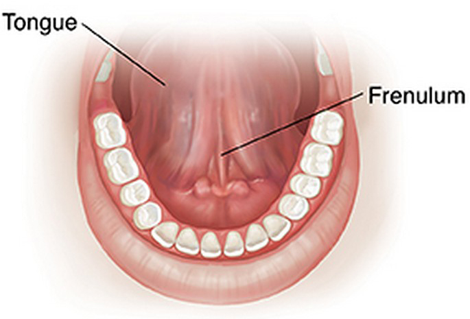 Связка языка. Воспаление уздечки языка.