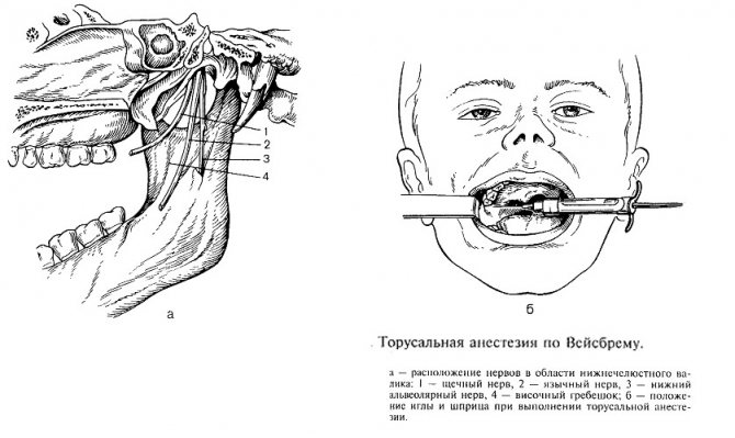 Проведение проводниковой анестезии. Мандибулярная анестезия методика. Торусальная анестезия нижней челюсти. Проводниковая анестезия на нижней челюсти методика. Проводниковая анестезия в стоматологии торусальная.