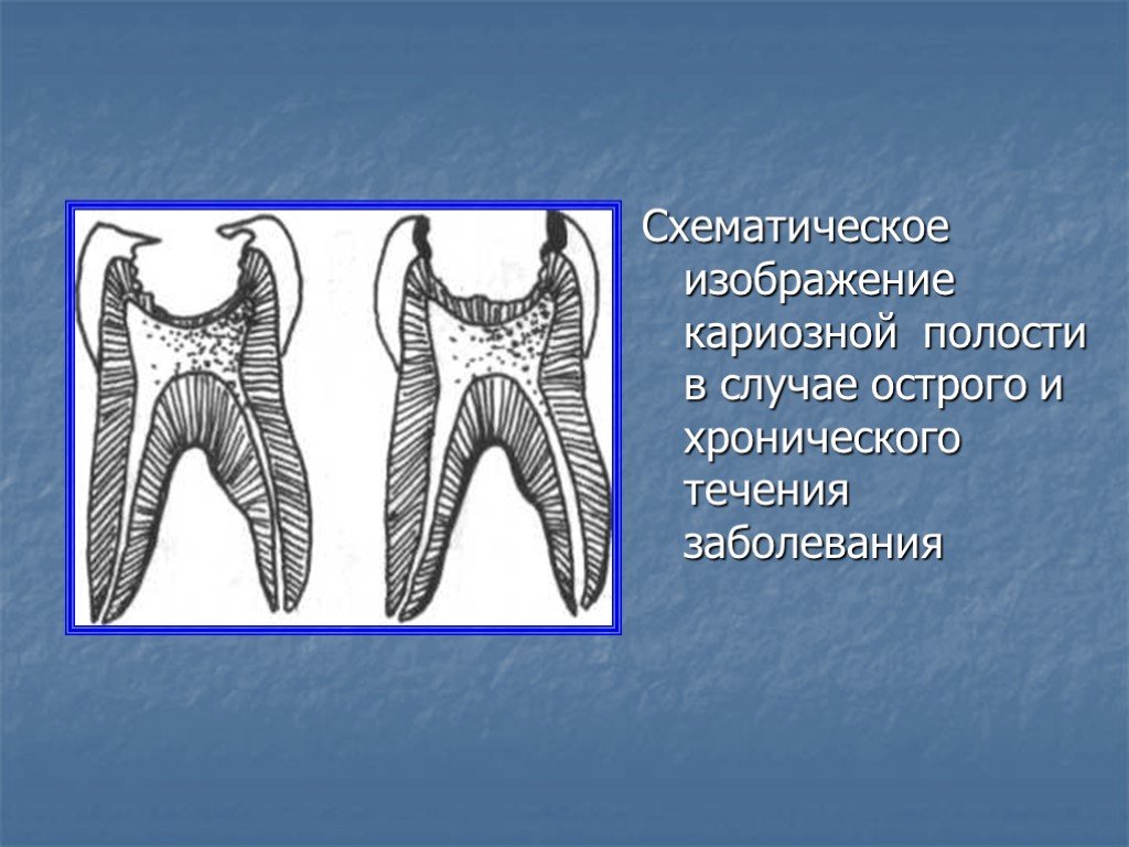 Полость острый. Острый и хронический кариес.