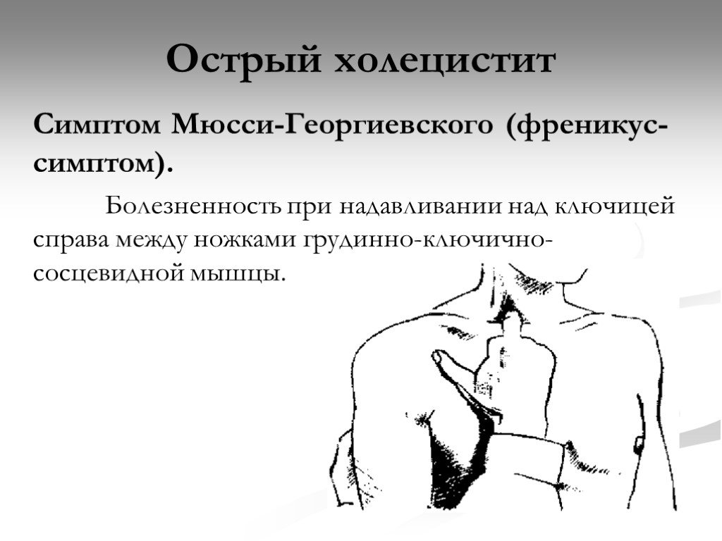 Боль при надавливании. Симптом Мюсси-Георгиевского френикус -симптом это. Симптом острого холецистита Ортнера. Симптом Мюсси-Георгиевского при остром холецистите. Симптомы Ортнера Мерфи Мюсси.