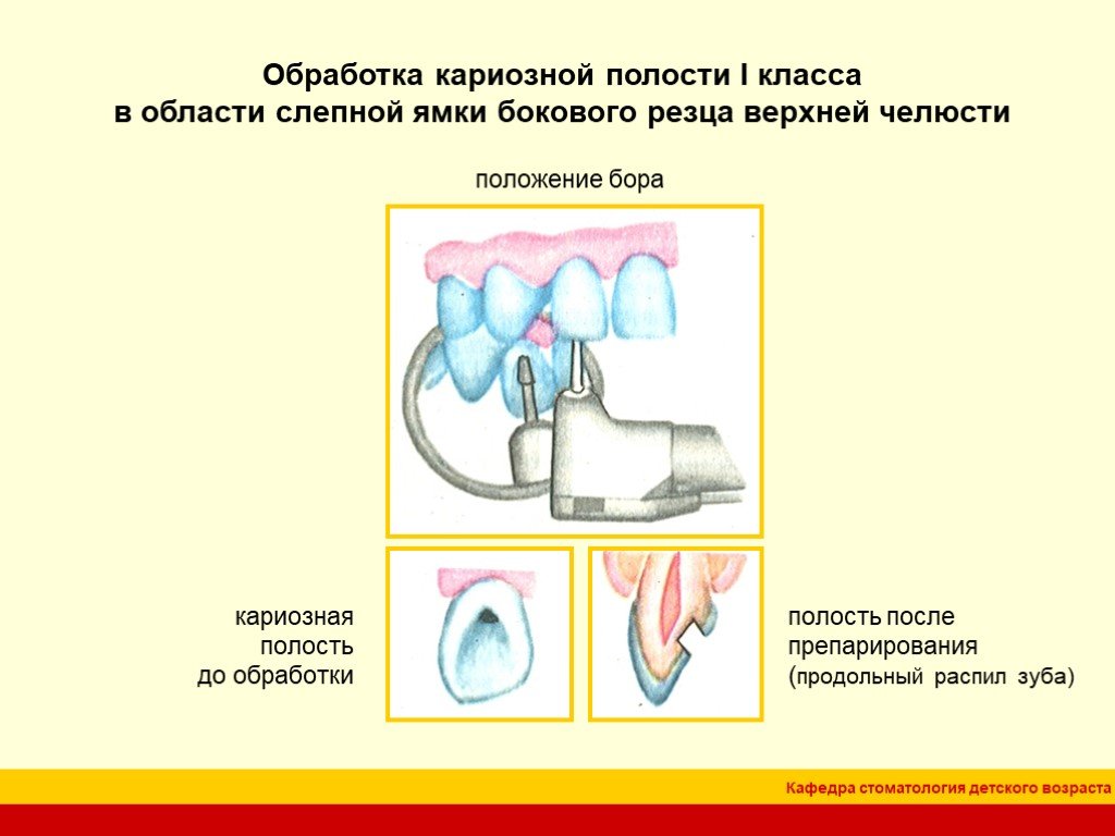 Края кариозной полости. Медикаментозная обработка кариозной полости препараты. Антисептики для медикаментозной обработки кариозной полости. Обработка кариозной полости.