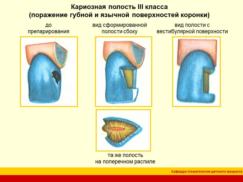 Полость впервые. 3 Класс Блэка препарирование кариозных полостей. Кариозная полость 3 класса по Блэку. Препарирование полости III класса по Блэку. Классификация кариозных полостей по Блэку препарирование.