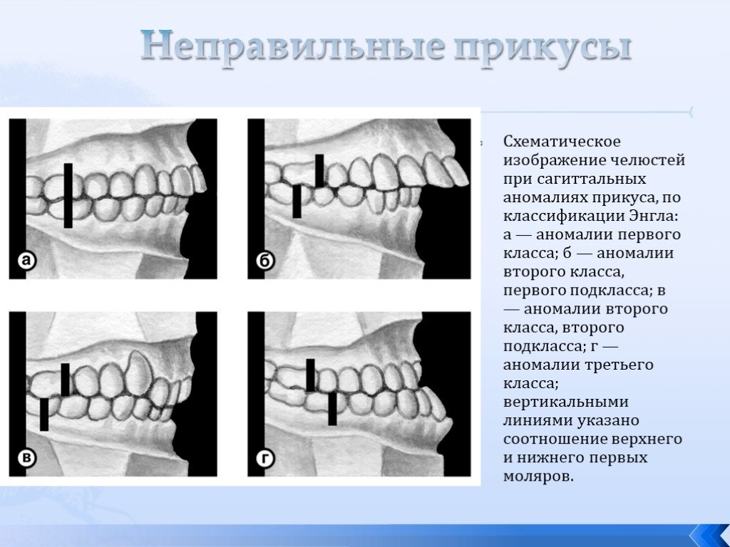 Мезиальный прикус презентация