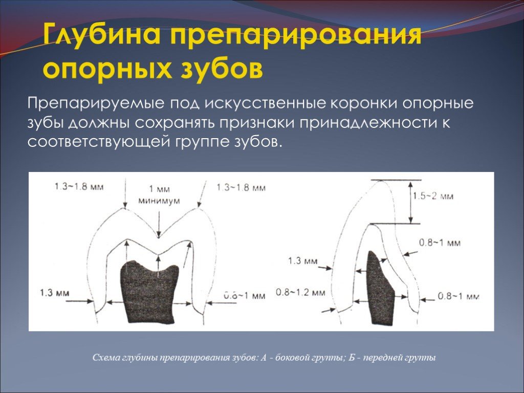 Препарирование под металлическую коронку схема