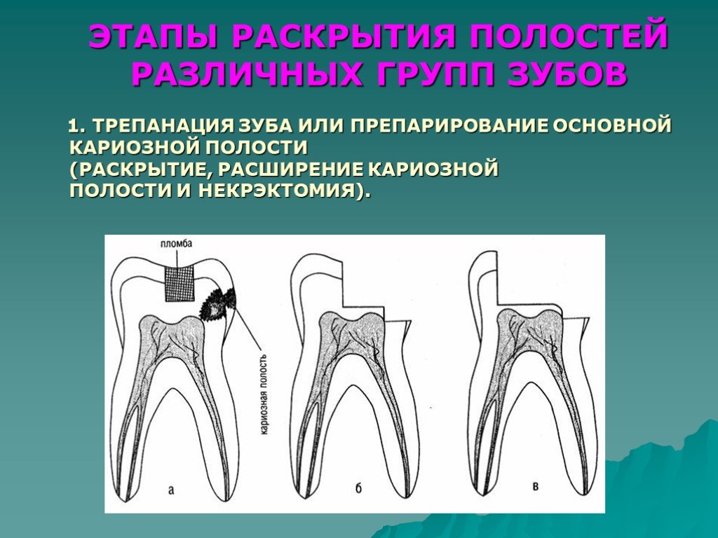 Полость стадия. Трепанация коронки интактного зуба это. Трепанирование коронки интактного зуба. Трепанация полости зуба. Этапы раскрытия полости зуба.