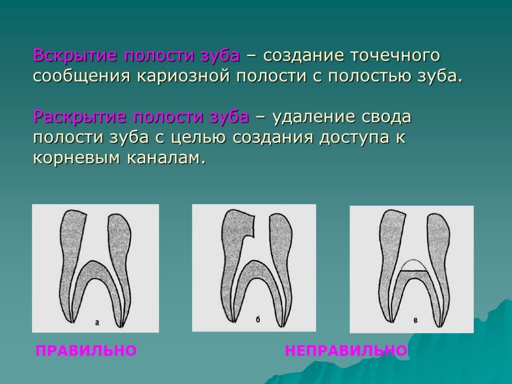 Полость проводить. Свод полости зуба пульпы. Раскрытие полости зуба. Вскрытие и раскрытие полости зуба. Этапы раскрытия полости зуба.