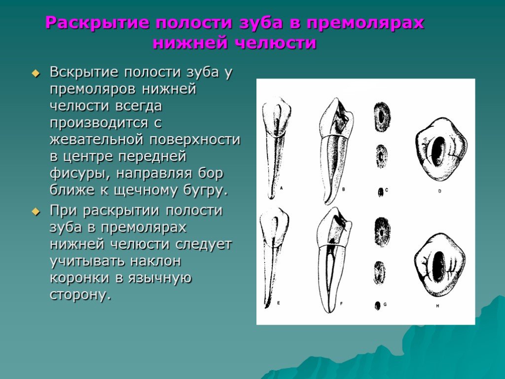 Полость зуба. Методика вскрытия и раскрытия полости зуба. Вскрытие полости зуба у премоляров нижней челюсти. Раскрытие полости зуба премоляров верхней челюсти. Раскрытие полости зуба премоляров нижней челюсти.