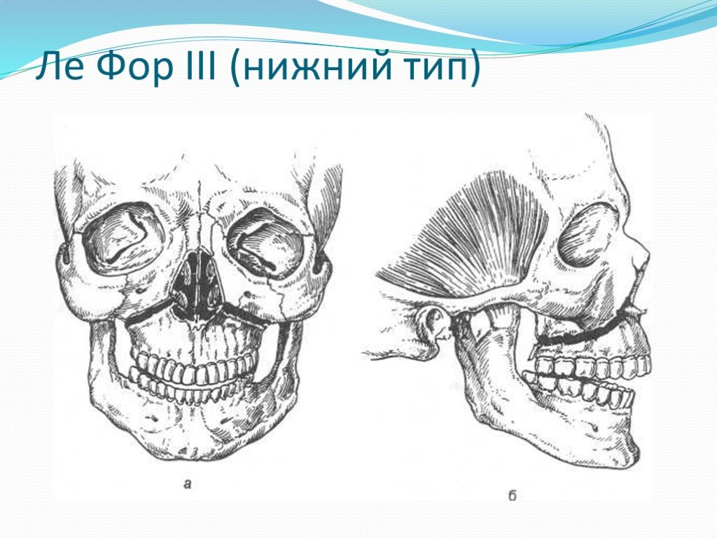 Верхний тип. Перелом верхней челюсти по Лефору 1. Средний перелом по Лефор верхней челюсти. Переломы верхней челюсти классификация Ле фор. Перелом верхней челюсти Лефор III.