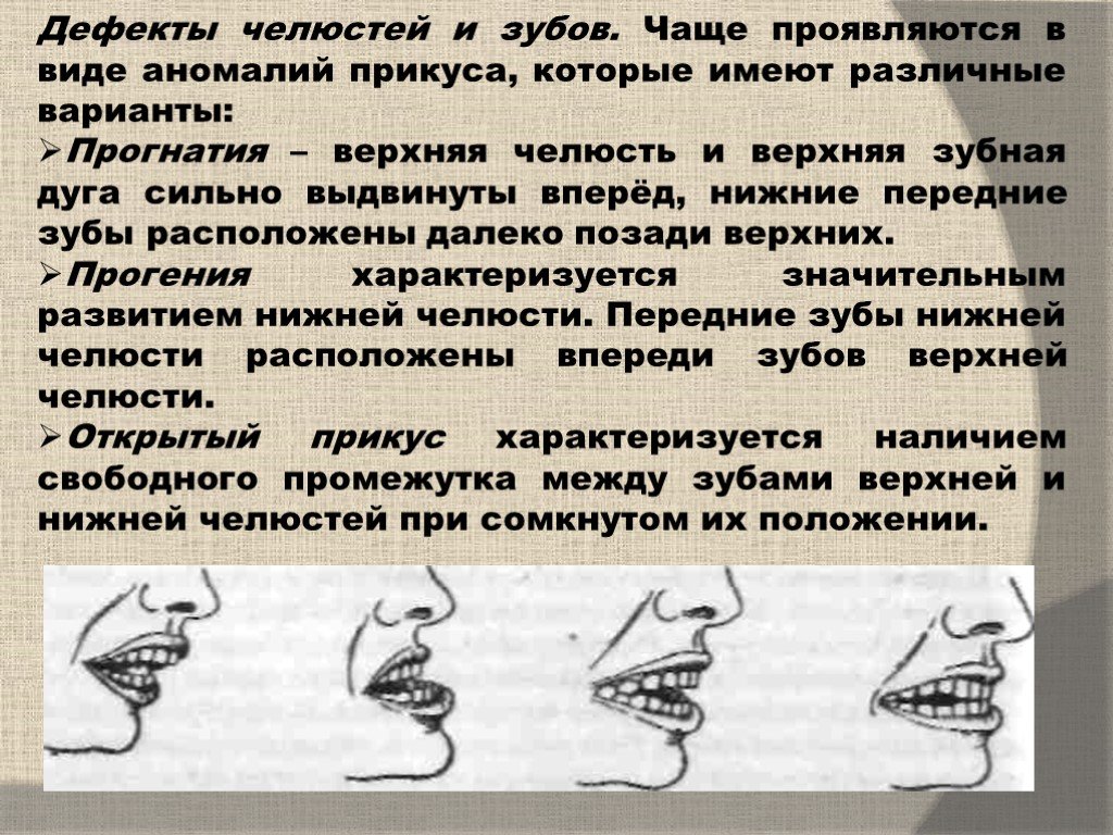 Виды аномалий. Аномалии прикуса прогнатия. Дефекты развития верхней челюсти. Аномалии развития верхней и нижней челюсти.