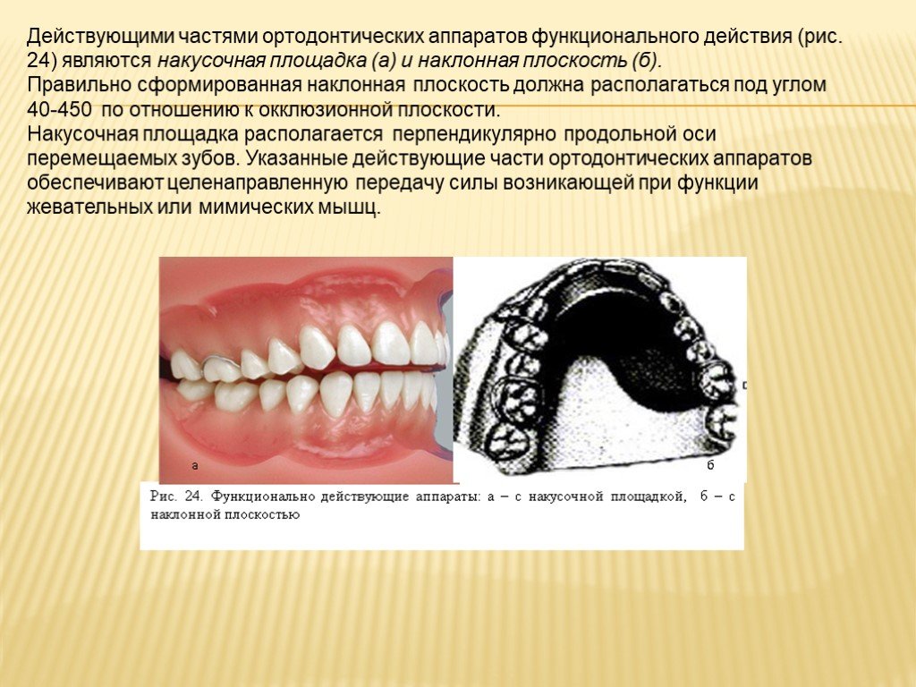 Действующие части. Функционально направляющие аппараты. Наклонная плоскость в Орто. Ортодонтический аппарат с накусочной площадкой. Функционально действующие ортодонтические аппараты.