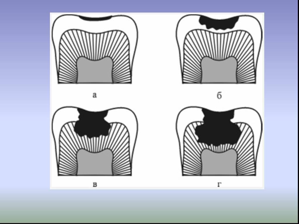 Полость стадия. Клинико-топографическая классификация кариеса. Топографическая классификация кариеса зубов. Клинико-топографическая классификация кариозных полостей.. Поверхностный кариес классификация.