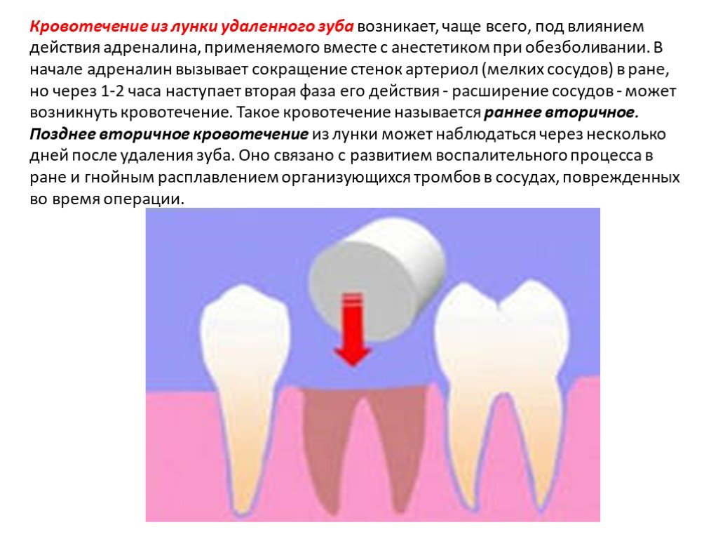 Остановить кровотечение удаления зуба
