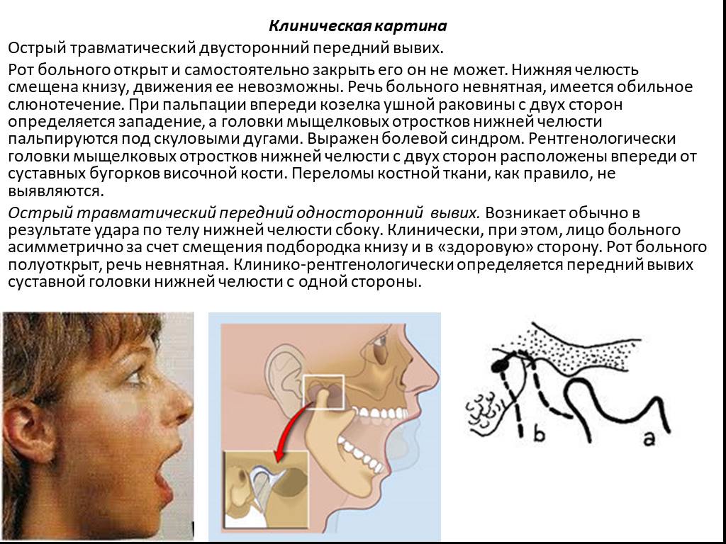 При открытии рта болит ухо. Клинические симптомы вывиха нижней челюсти. Вывих височно-нижнечелюстного сочленения (вывих нижней челюсти). Двусторонний вывих нижней челюсти.