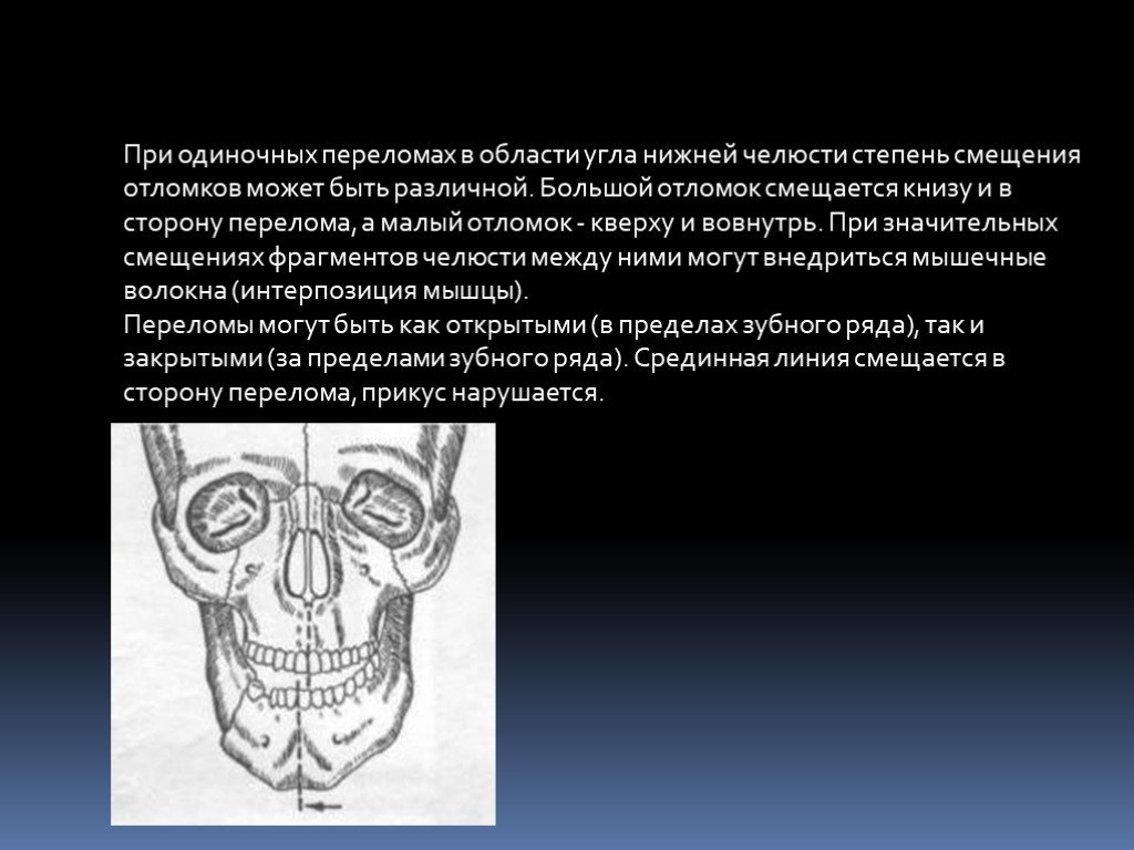 Перелом нижней. Типичная локализация переломов нижней челюсти. Клиника перелома в области угла нижней челюсти. Смещение отломков нижней челюсти. Смещение отломков при переломе челюсти в области угла.